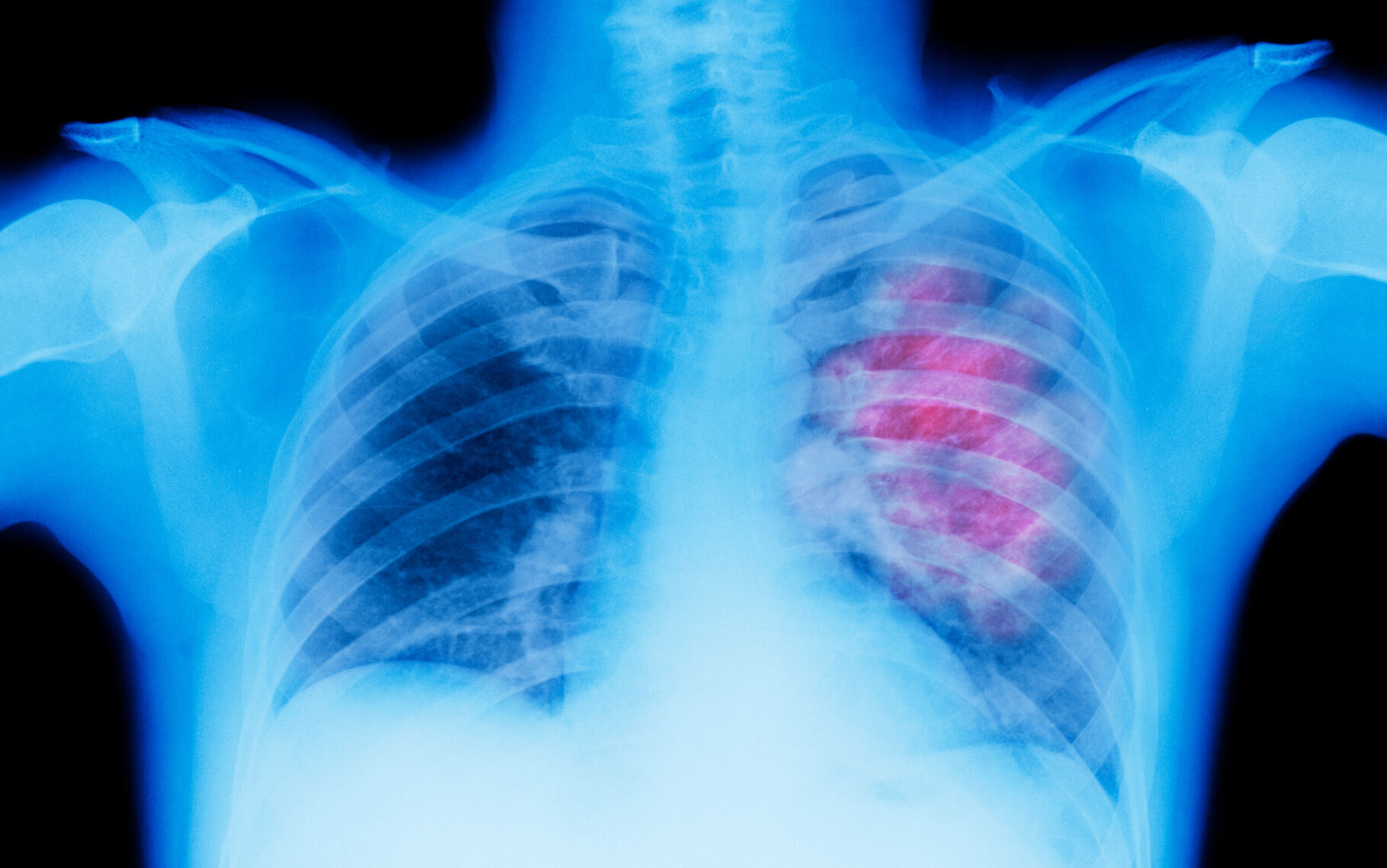 US death rates are falling for many types of cancer, but not all, report says